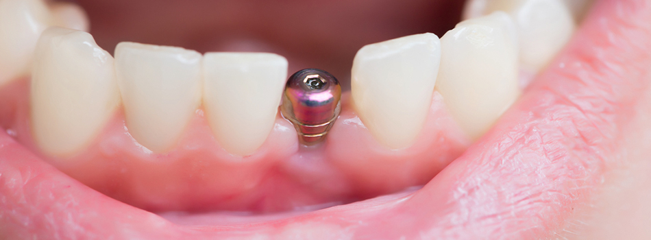 Cost of dental implants
