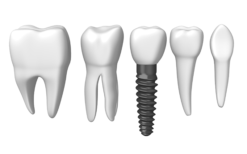 Dental Implants