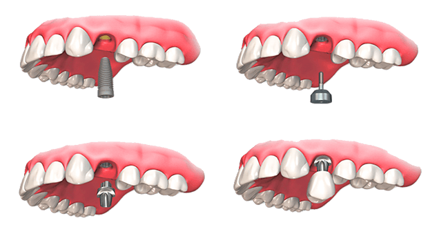 dental implants