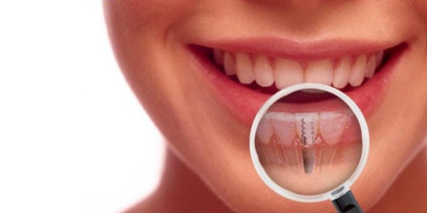dental implants