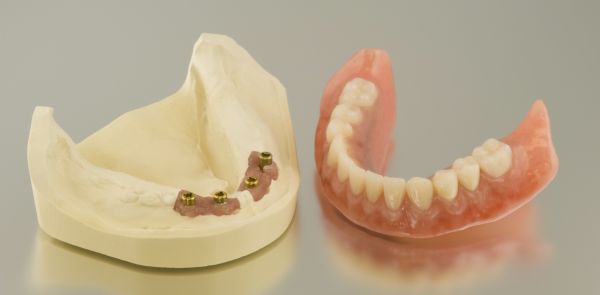 Dental Implants and removable dentures