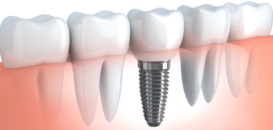 Dental Implants