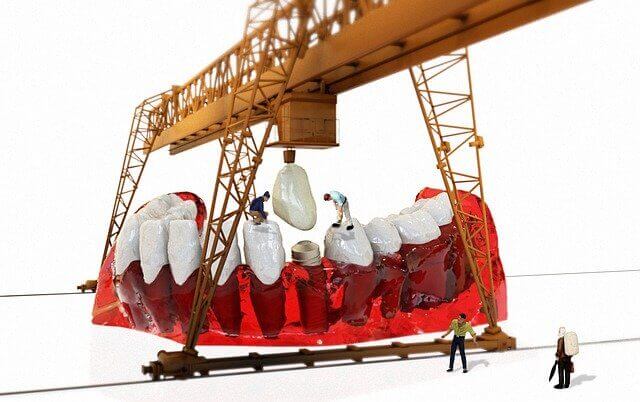 An Overview of Same Day Dental Implants