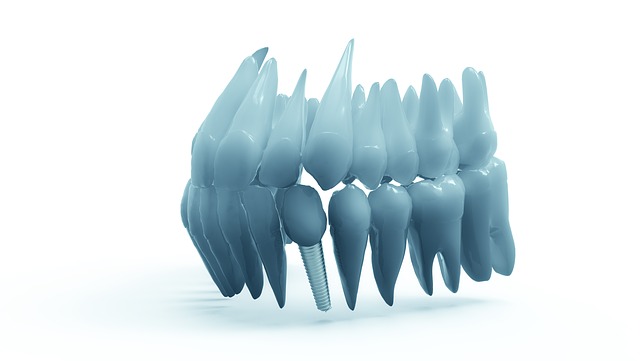Dental Implants