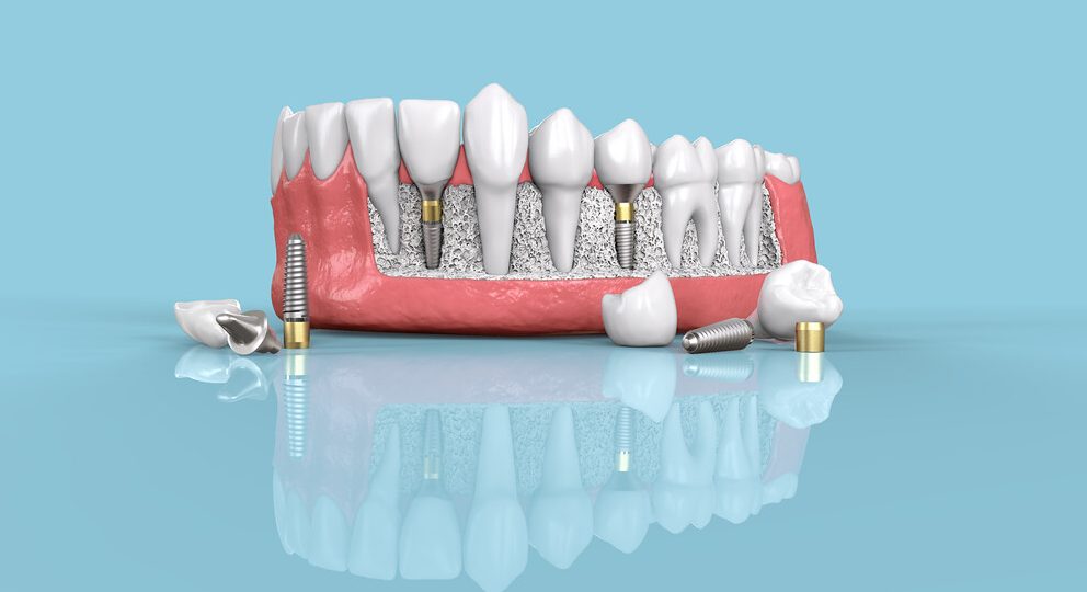 Dental Implants