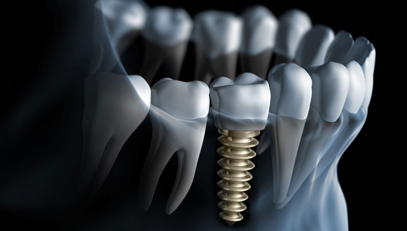 Mini Dental Implants to enhance your Smile!