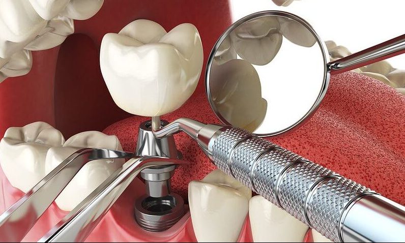 Dental Implants