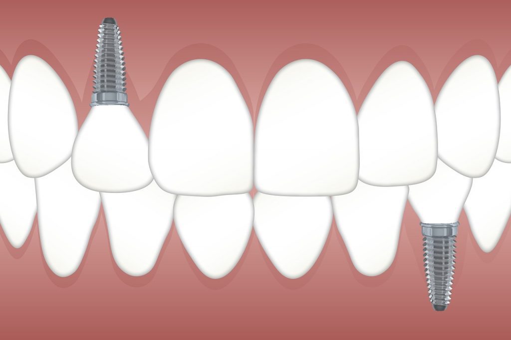 FAQs on Dental Implants!