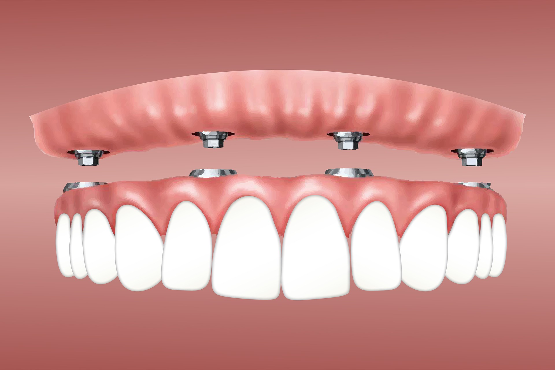 dental implants Melbourne