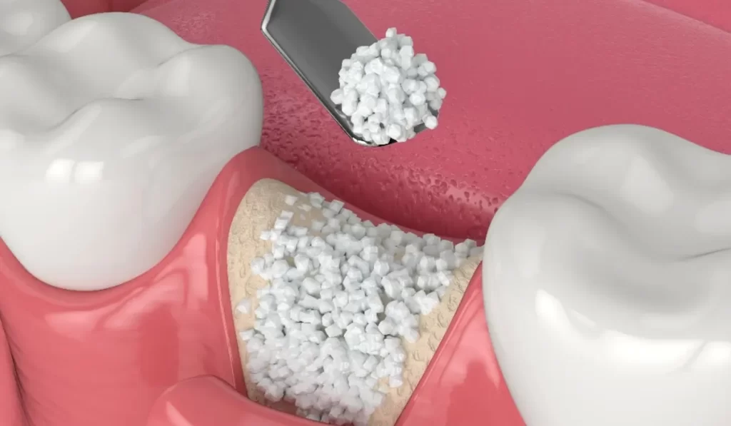 Dental Implants and Bone Grafting