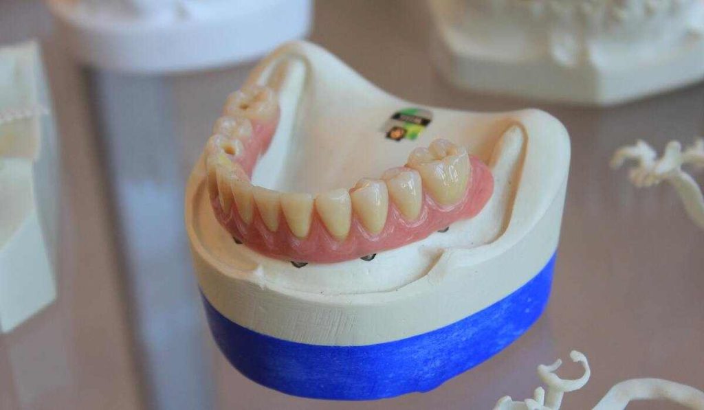 Dental implants in Melbourne