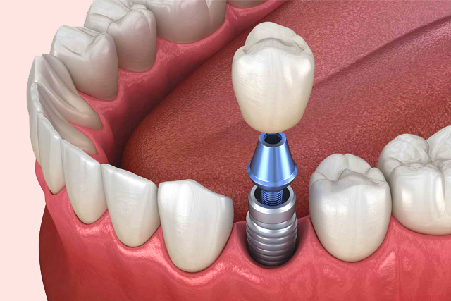 dental implants cost - dental implant professionals - melbourne