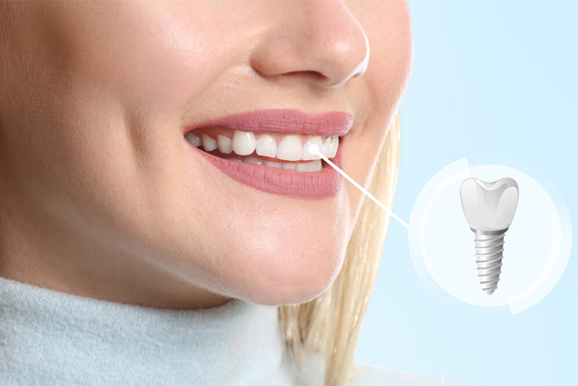 dental implants near me - dental implant professionals - melbourne