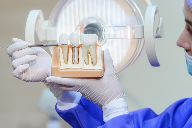 Tooth Replacement - dental implant professionals - melbourne