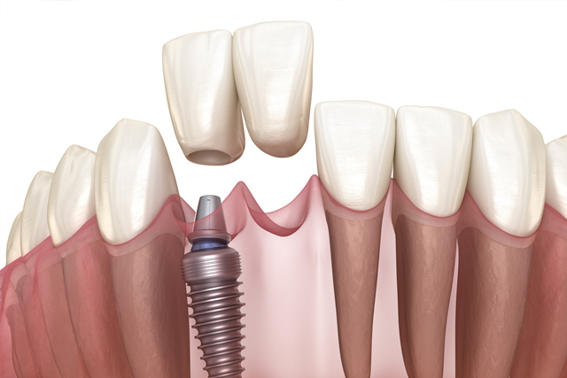 Dental Implants Everything You Need to Know - dental implant professionals - melbourne