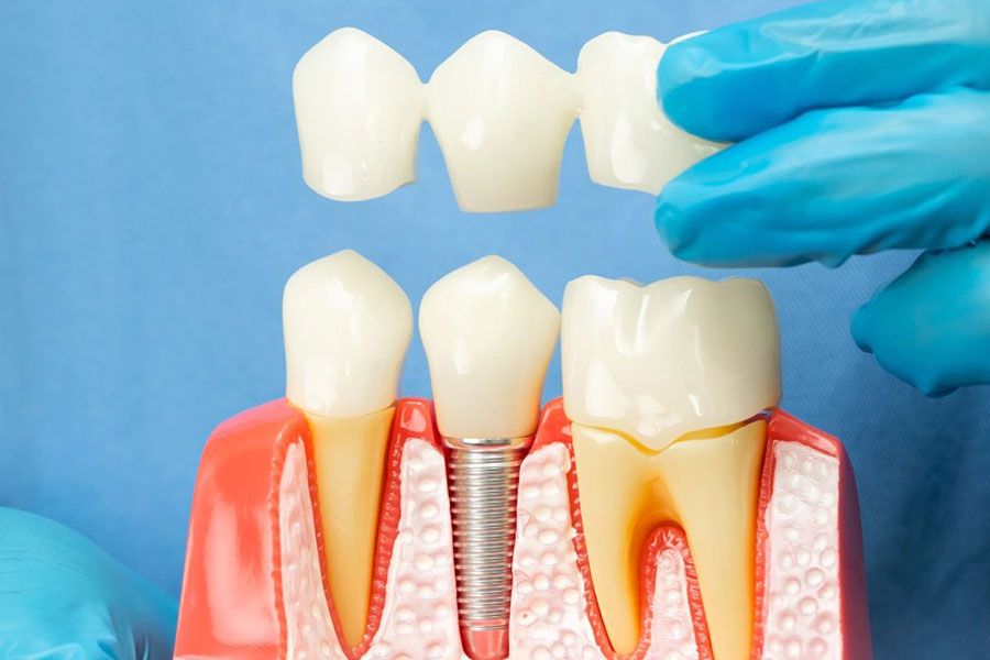 Dental implantation success with long-lasting implant results