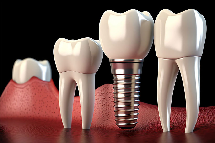 Impact of nicotine on dental implant failure risk in melbourne