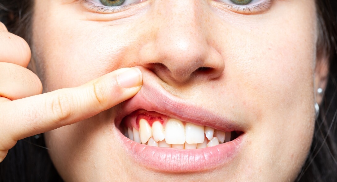 Bleeding from the tooth