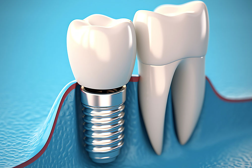 Dental implantation model
