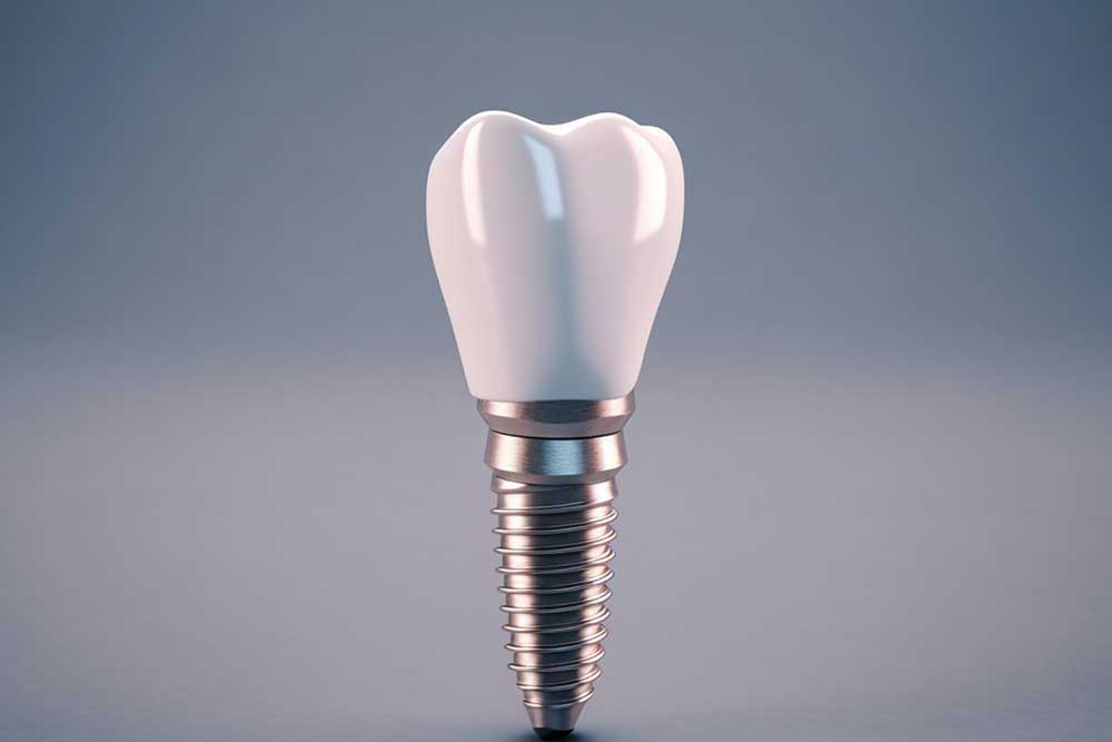 Single dental implant model showing titanium screw 