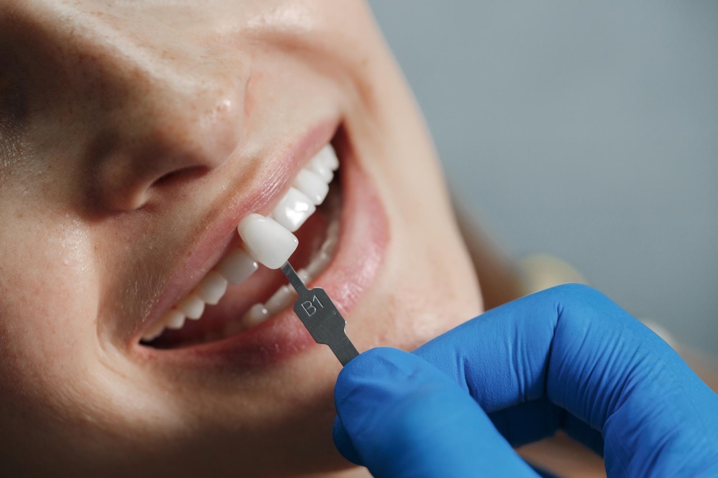 Teeth whitening at dental clinic offering affordable dental implants near me prices